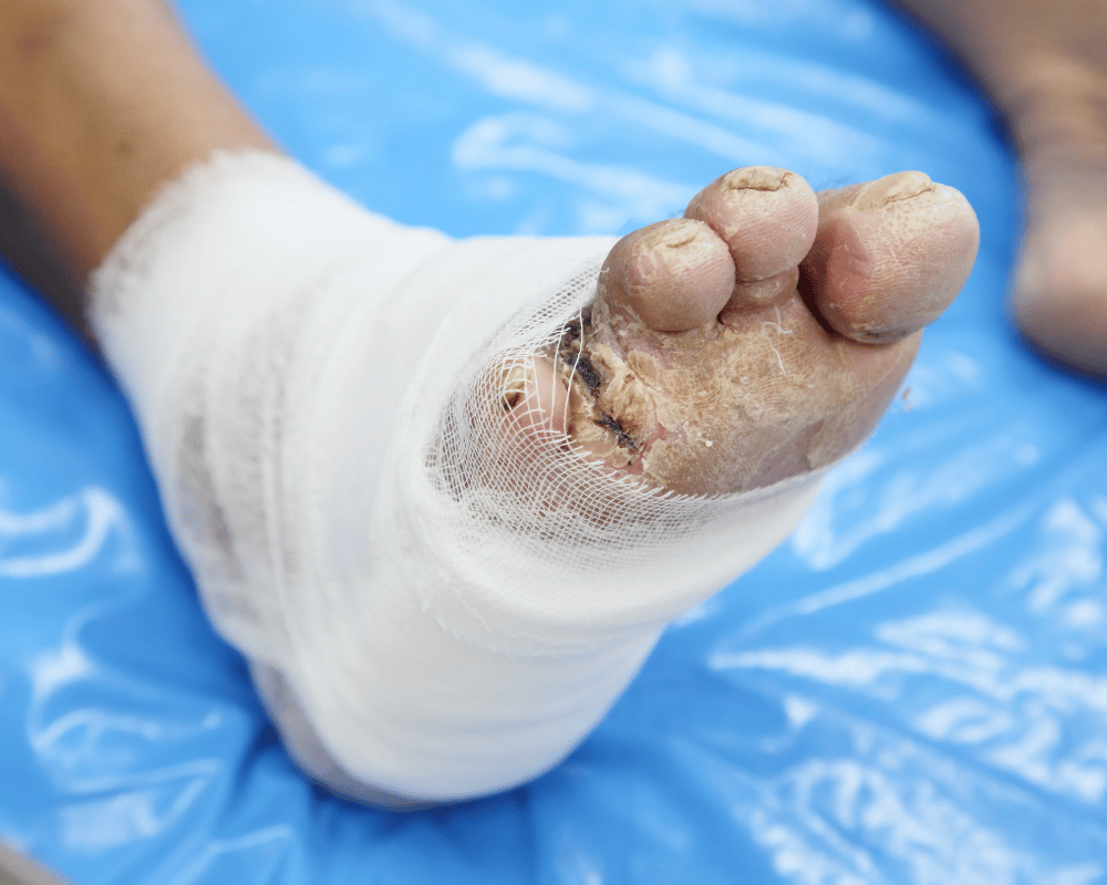 Luka Kaki Diabetes, Kenali Penyebab dan Gejala yang Mungkin Muncul